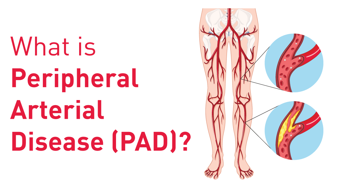 Peripheral Arterial Disease (PAD)